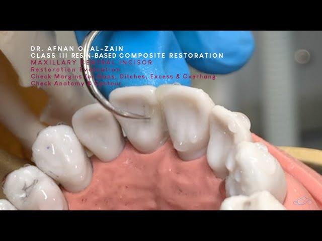 Class III composite restoration (1) –Maxillary central incisor (#11) moderate to large - Arabic عربي