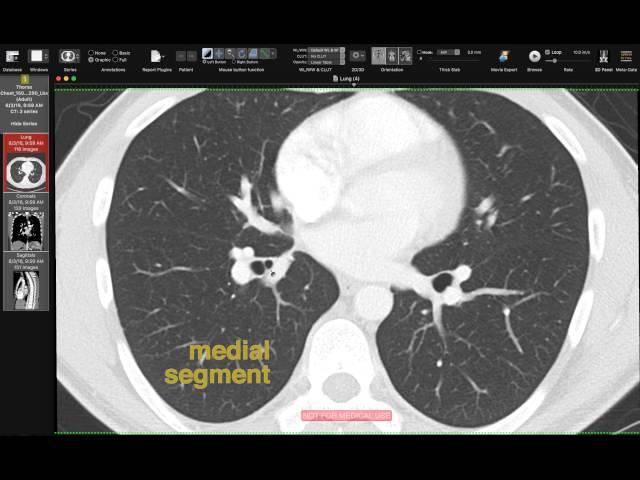 Lobar and Segmental Lung Anatomy on CT