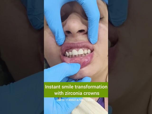 Instant Smile Transformation with Zirconia Crowns- Dr. Srishti Bhatia