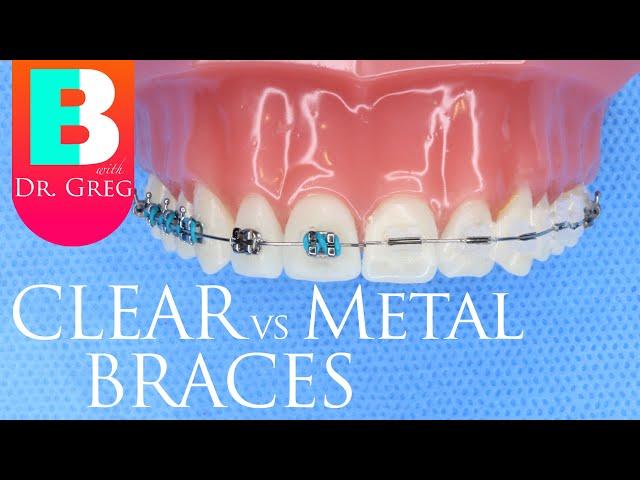 Clear Braces vs Metal Braces