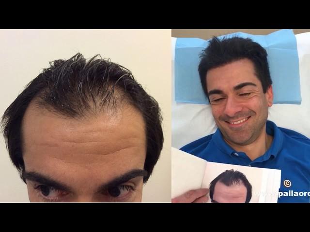 Trapianto capelli con tecnnica Micro FUE HD dopo 5 mesi