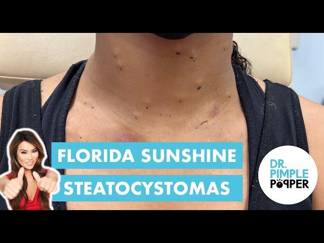 Florida Sunshine Steatocystomas