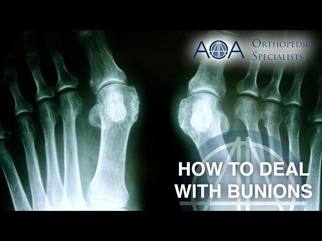 AOA Orthopedic Specialists - Dr. Don Stewart - How to Deal with Bunions