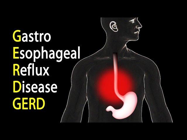 GERD - Gastroesophageal Reflux Disease or Gastric Reflux, Animation.