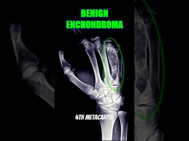 Enchondroma #bones #xray #health