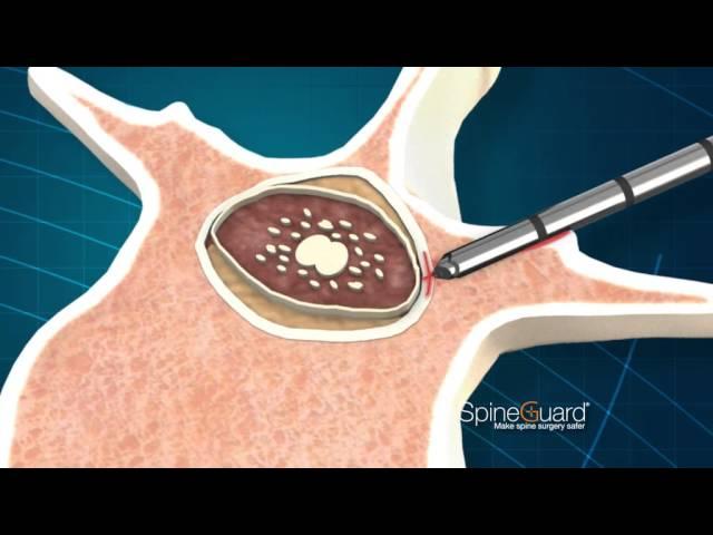 PediGuard® Cannulated - Safe Pedicle Screw Placement