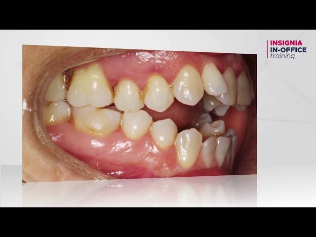 Orthodontic Challenging Case: Open Bite