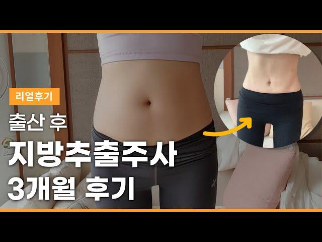 66.8kg→58.2kg 지방추출주사 3개월 동안 신체변화 + 디테일한 후기