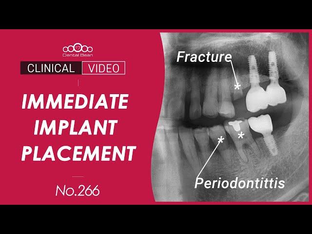 #25, 35, 36 Immediate implant placement after extraction - [Dr.Cho Yongseok]