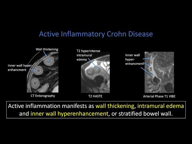 Crohn Disease: Part 1   Active Inflammation