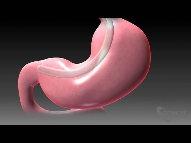 Sleeve Gastrectomy