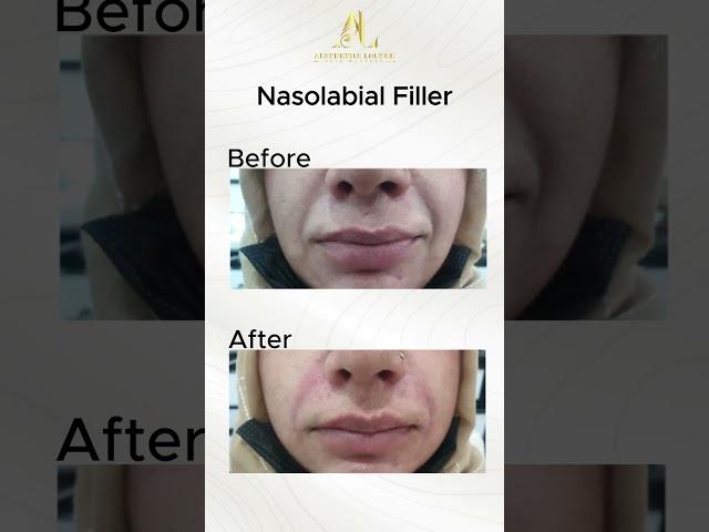 Nasolabial Filler | Dr Aftab afzal | Aesthetics Lounge Isb #beauty #filler #islamabad