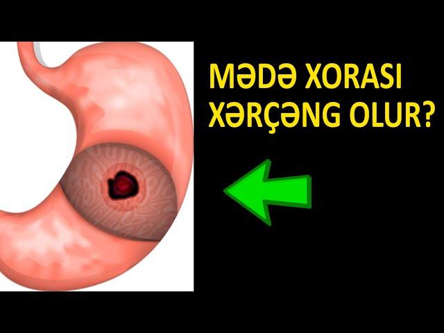 Mədə xorası xərçəngə çevrilir? - Həkimdən şok açıqlama