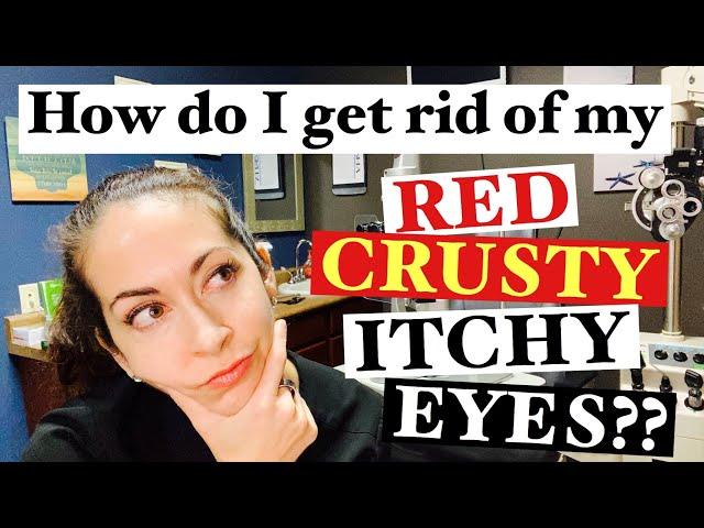 Blepharitis | 2 Easy steps to banish red, crusty, itchy eyes | The Eye Surgeon