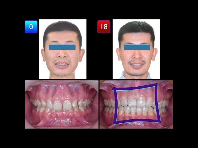 Solving Deep Bite with Retroclined Upper Incisors & U7 Crossbite｜【Chris Chang Ortho】CC773