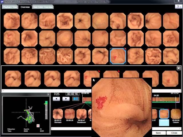 WEO Video Capsule Endoscopy (VCE) Library: clinical case 51