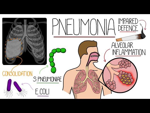 Pneumonia Explained Clearly (Includes Community & Hospital Acquired)