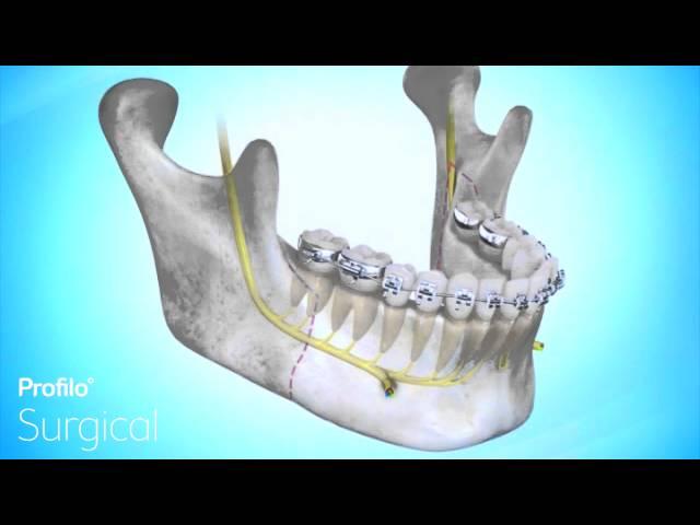 BSSO | Lower Jaw Advancement Surgery