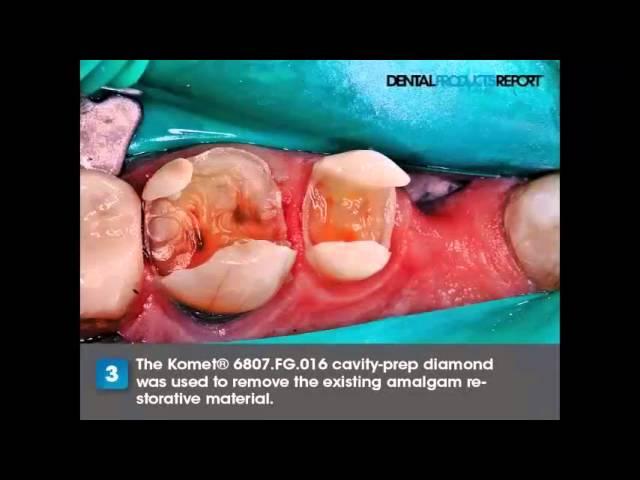 How To Provide Multi-Disciplinary Dentistry Using Komet's Crown Kit