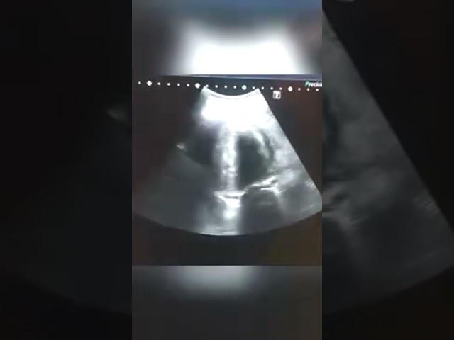 Intra Uterine Pregnancy with Uterine Fibroid#shortsfeed #mother #motherhood #pregnancy #pregnant