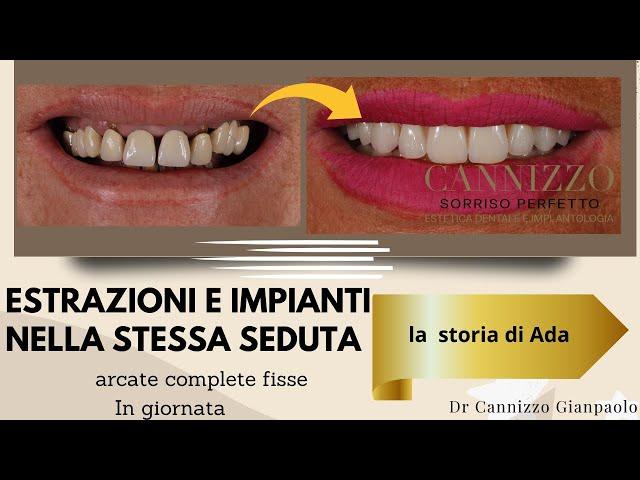 ALL ON FOUR - impianti dentali