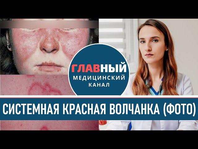 Как выглядит Красная Волчанка (фото 1-9). Симптомы системной красной волчанки. Болезнь Либмана-Сакса