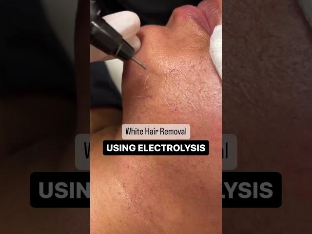 Electrolysis Hair Removal