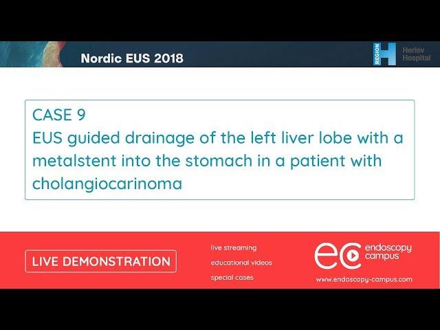 Livedemo | Nordic EUS 2018 | EUS guided drainage of the left liver