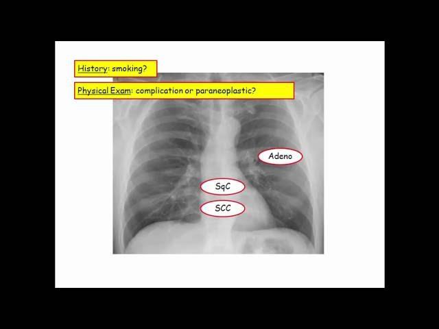 12DaysinMarch, Pulmonary Neoplasm for USMLE Step One