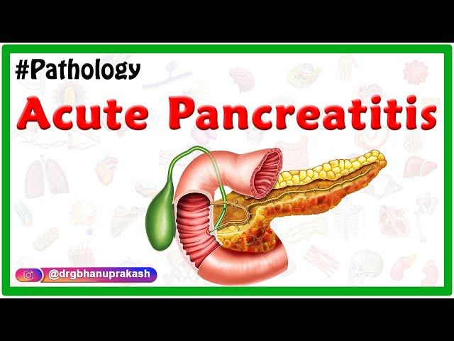 Acute Pancreatitis: Etiology , signs and Symptoms, pathophysiology , Diagnosis, Treatment