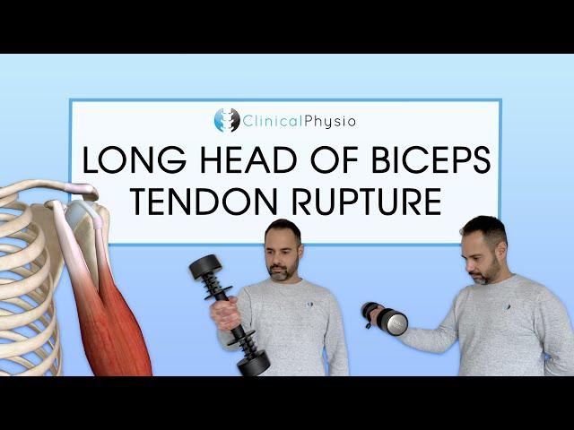 Long Head Biceps Tendon Rupture | Expert Physio Review