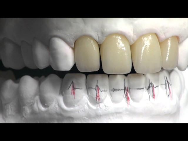 Veneering of Lithium Disilicate by Stefano Lombardo and Diego Foletto