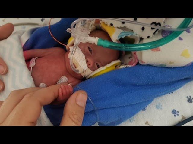 Youngest Surviving Premature Baby Stuns Doctors