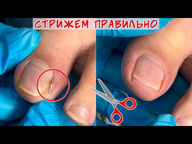 Ingrown toenails / Nail prone to ingrowth