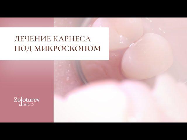 Как лечится кариес под микроскопом?