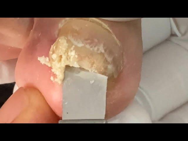 Why Your Toenail Fungus Treatment Isn't Working