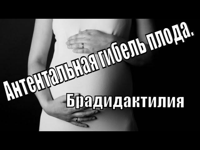 Антенатальная гибель плода. Брадидактилия.