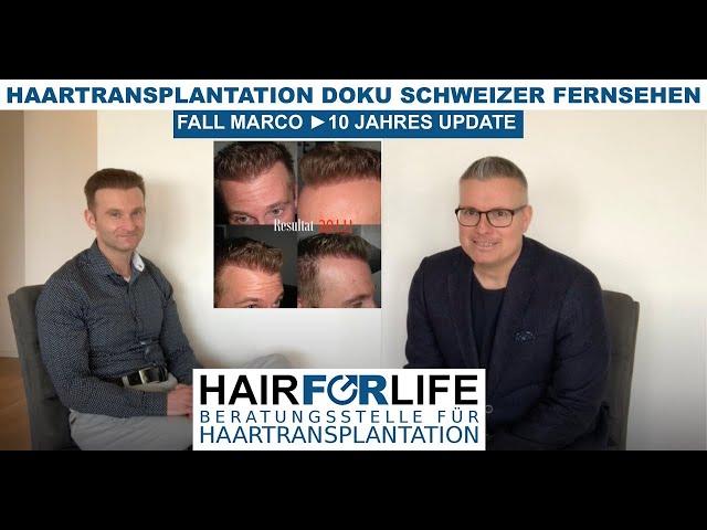 Hair Transplant documentary Switzerland TV - Marco from Germany ► 10 year update and consultation!