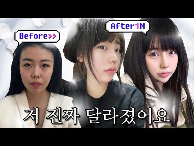 와 이건 아니지~ 어색함 1도 없는 완벽한 코라인 | 코수술 리얼모델 후기