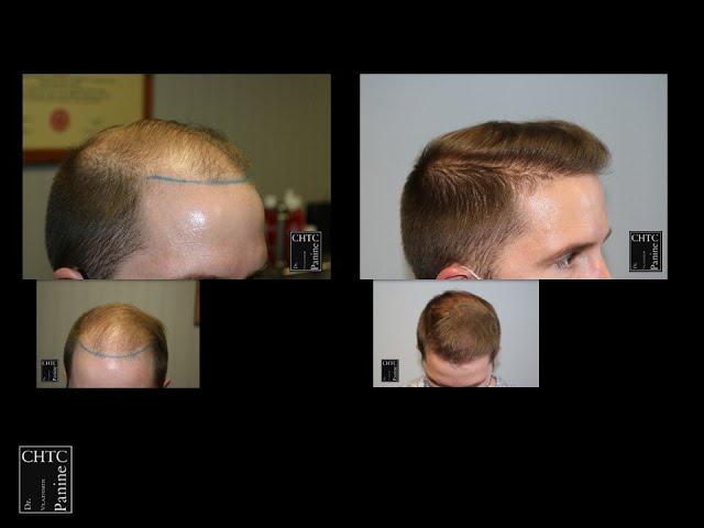 Before and After Photos of FUE Hair Transplant with 2,603 Grafts at CHICAGO HAIR TRANSPLANT CLINIC