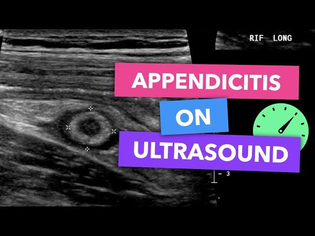 Appendicitis on ultrasound - Radiopaedia's Emergency Radiology Course