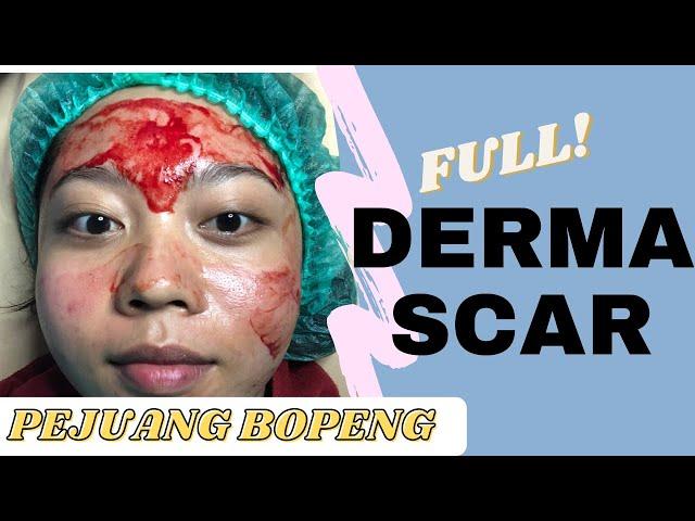 FULL PROSES DERMASCAR | Treatment Bopeng