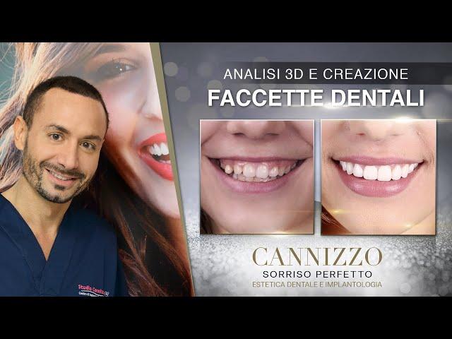 Analisi 3D e Creazione Faccette Estetiche