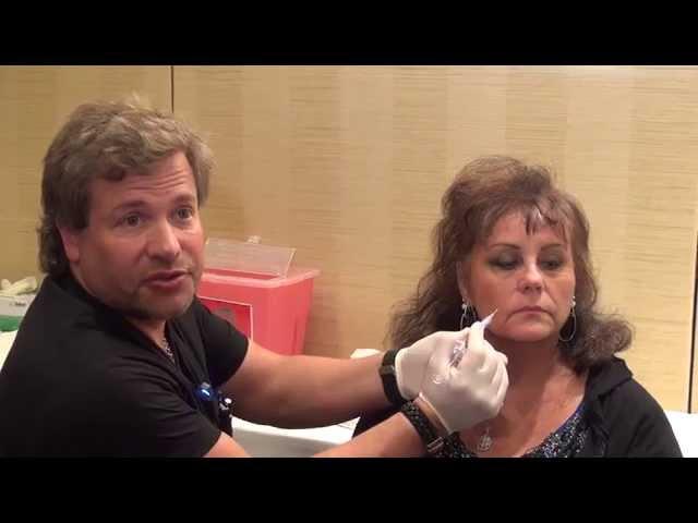 Dermal Filler Training - Nasolabial folds Injections - Empire Medical Training