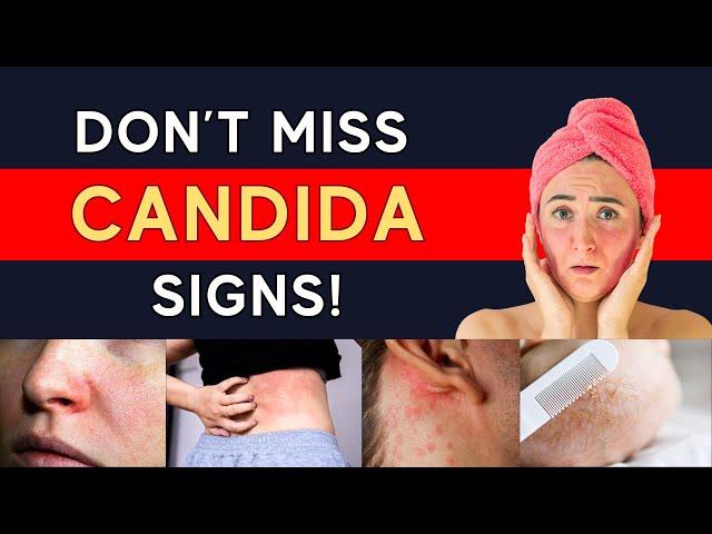 How To Identify Candida Overgrowth (Test Options + Symptoms Especially lf You Have Skin Rashes)