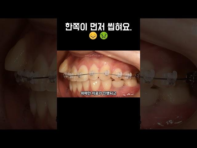 씹을 때 오른쪽이 먼저 닿아요. 불편해요.  #교정중생기는