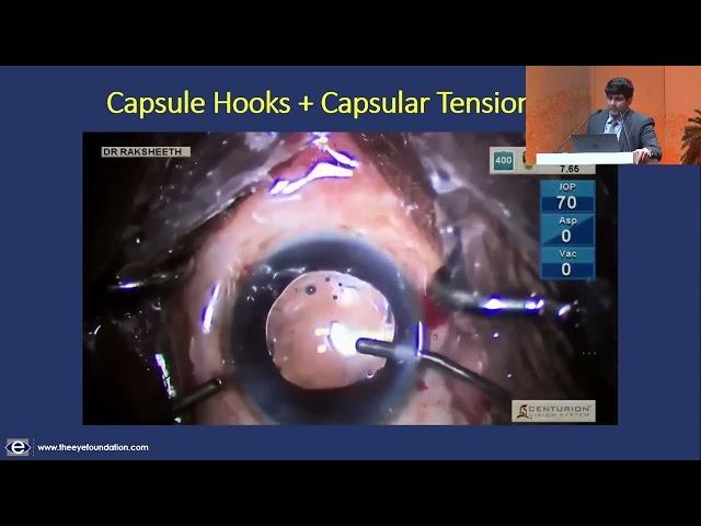 AIOS2025 IC323 T Dr  Raksheeth Nathan Rajagopal Top pearls for Zonulopathy in cataract