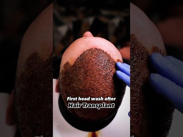 It’s not just a regular head wash  | Hair Transplant Clinic