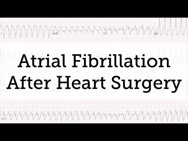 Atrial Fibrillation (AFib) After Heart Surgery: Is it Common?