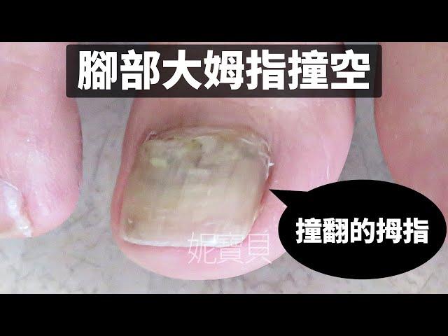 Correction of foot nails - Treatment of hollow nails on thumbs